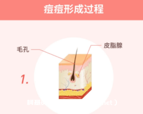 丁香妈妈 科学战痘攻略